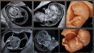 độ mờ da gáy cao