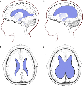 giãn não thất thai nhi