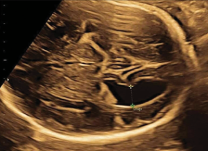 giãn não thất ở thai nhi