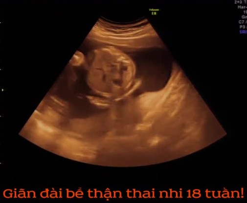 giãn bể thận thai nhi