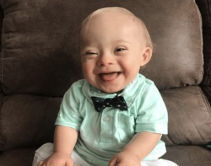 hội chứng down là gì