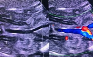 Bất sản thận 2 bên