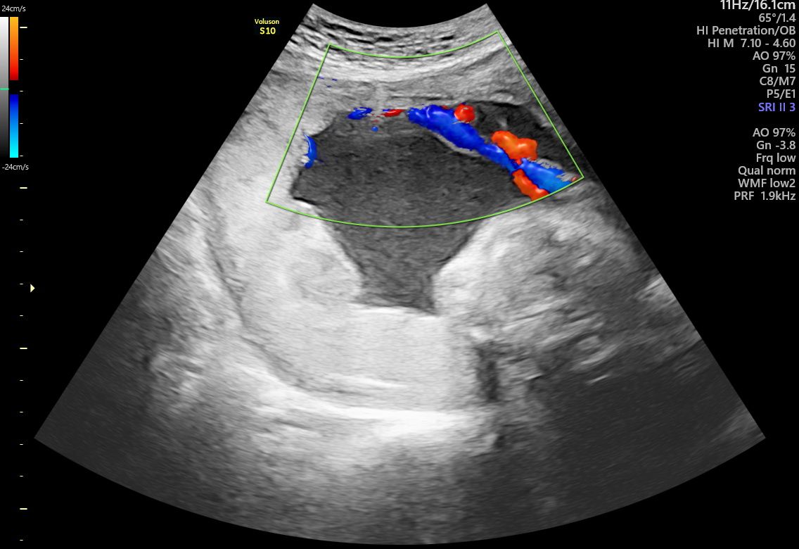 Ảnh Doppler màu trong lần siêu âm thai 24 tuần 6 ngày có kết luận dây rốn bám màng