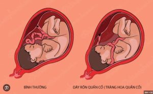 Dây rốn quấn cổ