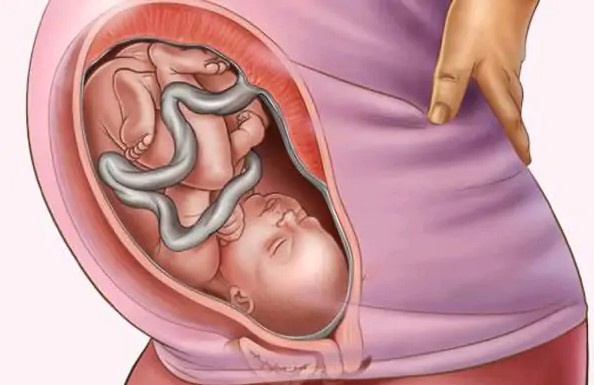Dây rốn quấn cổ