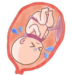 Dây rốn quấn cổ 2 vòng