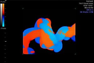 Dây rốn thắt nút