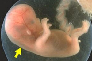 độ mờ da gáy cao