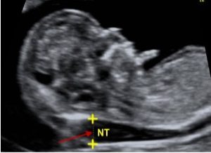 siêu âm độ mờ da gáy