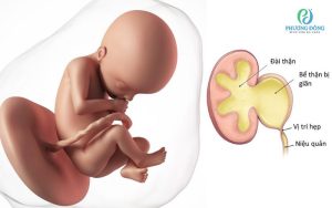 giãn bể thận thai nhi
