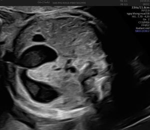 tắc tá tràng bẩm sinh