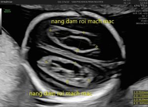 nang đám rối mạch mạc