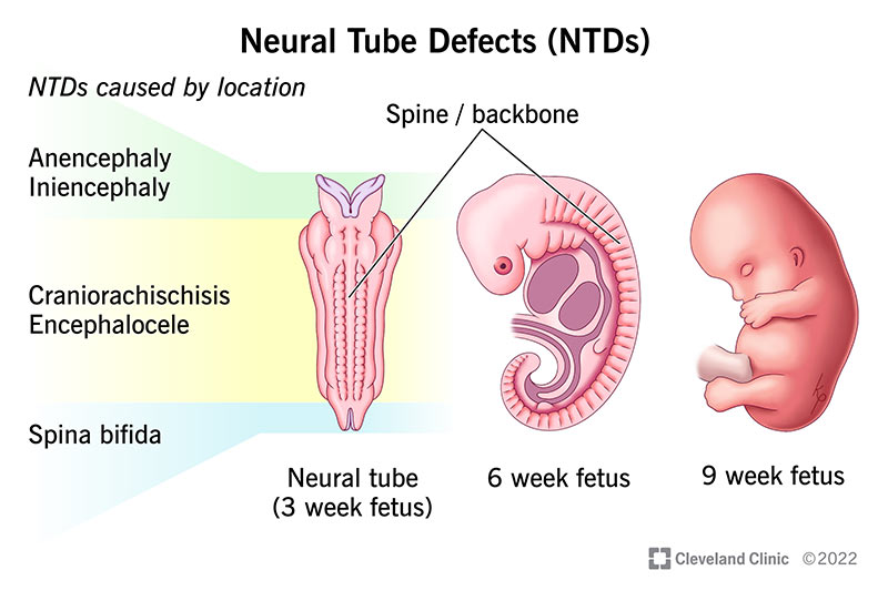 dị tật ống thần kinh