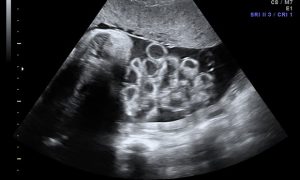 Nguyên nhân thai nhi bị hở thành bụng