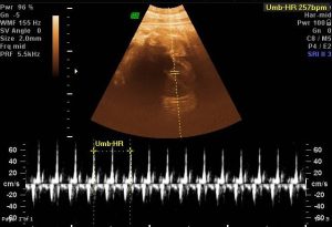 Rối loạn nhịp tim thai nhi