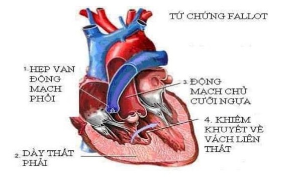 Tứ chứng fallot