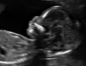 Bất sản xương mũi