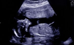 Nguyên nhân bất sản xương mũi