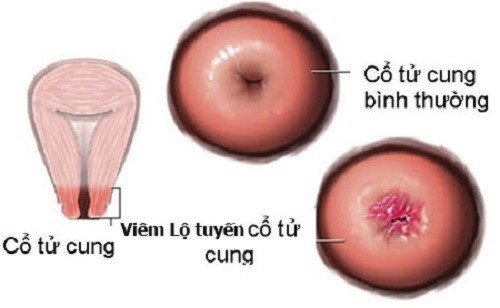 Viêm lộ tuyến khi mang thai