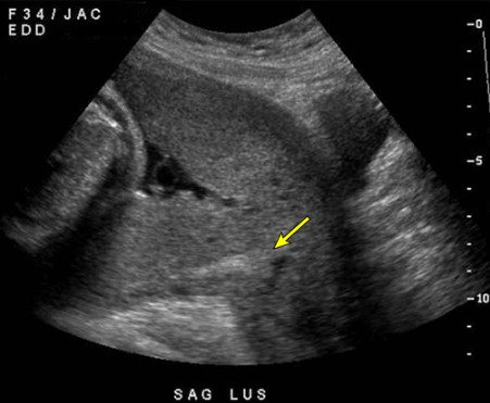 Hình siêu âm minh họa vị trí bánh rau gần hoặc che lỗ trong cổ tử cung