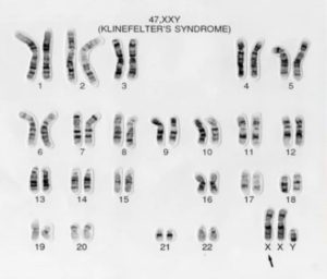 Hội chứng klinefelter