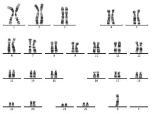 Hội chứng turner