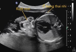 Hở thành bụng bẩm sinh