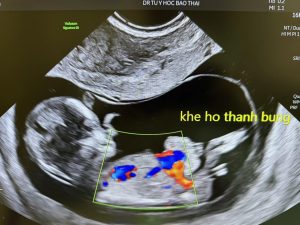 Khe hở thành bụng thai nhi