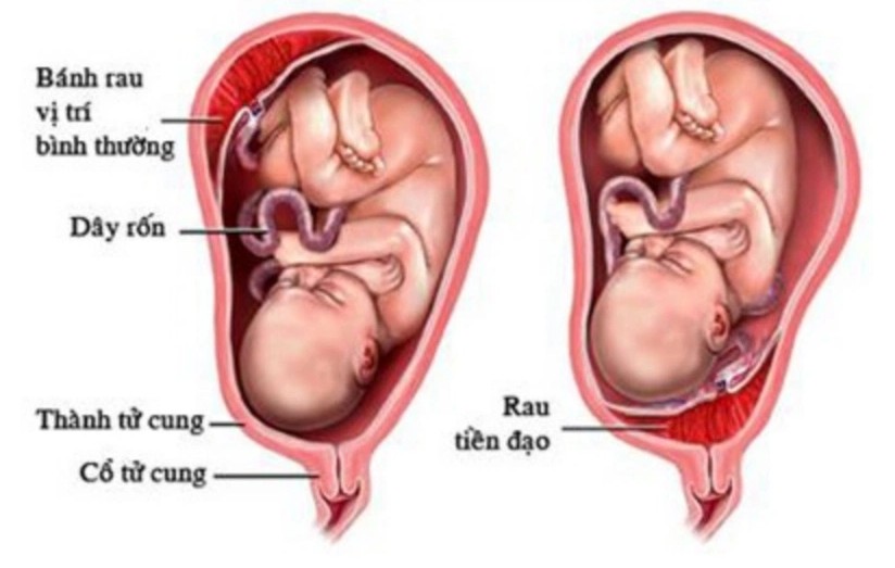 Sơ đồ minh họa vị trí bánh rau trong rau tiền đạo