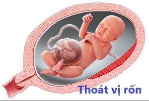 thoát vị rốn thai nhi