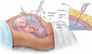 thoát vị rốn thai nhi