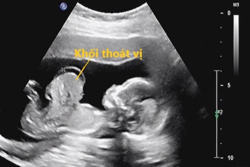 thoát vị rốn thai nhi