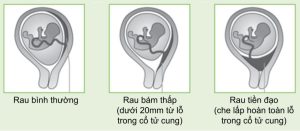 Nhau tiền đạo bám thấp