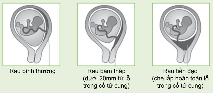 Nhau tiền đạo bám thấp