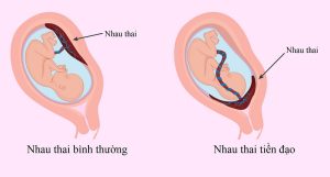 Nhau tiền đạo bao nhiêu tuần là mổ?