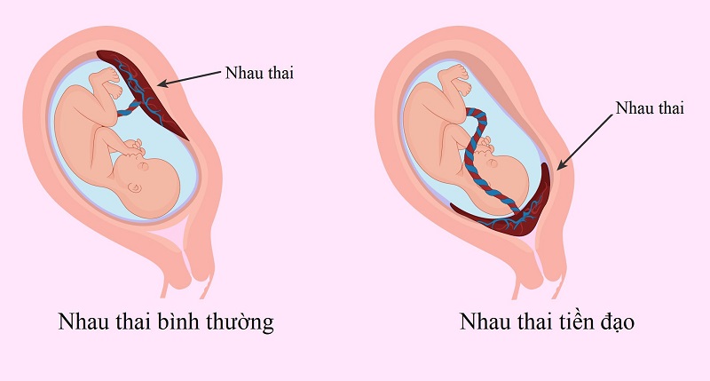 Nhau tiền đạo có sinh thường được không