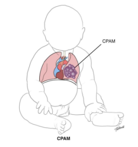 Hình ảnh mô phỏng CPAM bẩm sinh