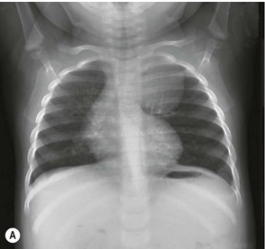 Ảnh chụp Xquang sau sinh của bệnh nhi phát có bệnh lý phổi tuyến nang bên trái