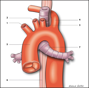 Giải phẫu ARSA động mạch dưới đòn phải lạc chỗ