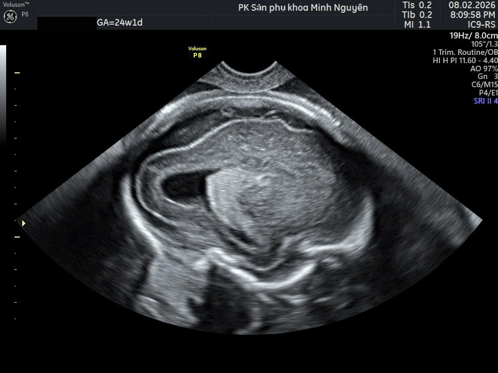 Giãn não thất thai nhi có giảm không