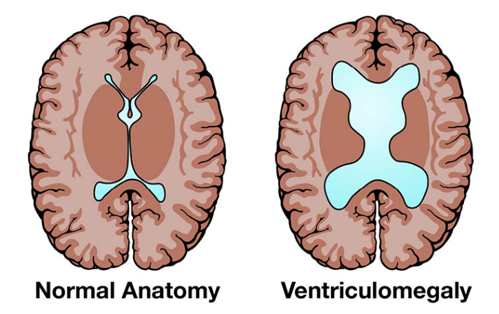 Giãn não thất thai nhi có giảm không