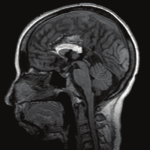 Hình ảnh MRI bất sản bán phàm thể chai