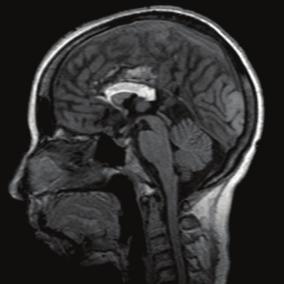 Hình ảnh MRI bất sản bán phàm thể chai