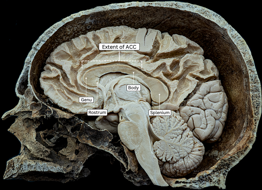 Hình ảnh so sánh thể chai bình thường trong bài bất sản thể chai hoàn toàn