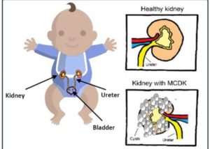 Hình ảnh loạn sản thận nhiều nang MCDK