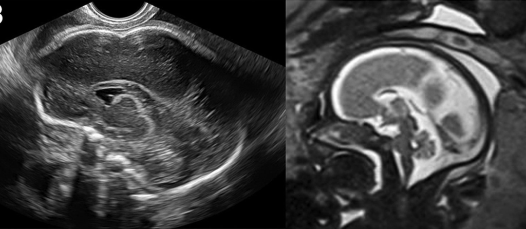 Hình ảnh siêu âm và MRI bất sản thể chai bán phần