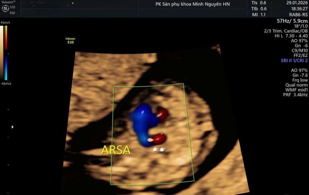 Nang màng nhện hố sau: Phát hiện trên siêu âm thai có nguy hiểm không? Câu chuyện của chị M. khi siêu âm ghi nhận nang màng nhện hố sau Chị M. mang thai 23 tuần đến khám lại sau khi siêu âm hình thái ở một cơ sở khác. Trên phiếu có ghi: nghi nang màng nhện hố sau. Chị không hiểu thuật ngữ này nghĩa là gì. Điều chị lo nhất là có phải con bị dị tật não nặng hay có ảnh hưởng trí tuệ sau này không. Đây là tình huống thường gặp khi phát hiện nang màng nhện hố sau trên siêu âm thai. Muốn tư vấn chính xác, cần hiểu rõ bản chất giải phẫu và phân biệt với các bất thường khác của hố sau. Nang màng nhện hố sau là gì? Nang màng nhện hố sau là một túi chứa dịch nằm trong khoang dưới nhện ở vùng hố sau của não. Hố sau là vùng phía sau của hộp sọ, chứa: Tiểu não Thân não Não thất IV Màng nhện là một trong ba lớp màng bao quanh não. Nang màng nhện hình thành khi có sự tách đôi hoặc bất thường phát triển của màng nhện, tạo nên một khoang chứa dịch giống dịch não tủy. Quan trọng: nang màng nhện không phải là khối u và không phải tổn thương ác tính. Siêu âm thai phát hiện nang màng nhện hố sau như thế nào? Trên siêu âm hình thái thai nhi, nang màng nhện hố sau thường biểu hiện là một vùng trống âm chứa dịch ở phía sau tiểu não. Khi khảo sát, cần đánh giá: Kích thước tiểu não Hình dạng thùy nhộng tiểu não Kích thước não thất IV Góc lều tiểu não Chu vi đầu và sự phát triển não theo tuổi thai Điều quan trọng là phân biệt nang màng nhện hố sau với các bất thường khác như: Dandy-Walker Giãn não thất sau Mega cisterna magna Thiểu sản thùy nhộng Việc phân biệt này có ý nghĩa tiên lượng hoàn toàn khác nhau. Nang màng nhện hố sau có nguy hiểm không? Tiên lượng phụ thuộc vào việc nang có đơn độc hay không. Trường hợp nang màng nhện hố sau đơn độc Tiểu não bình thường Thùy nhộng phát triển đầy đủ Không giãn não thất Không có dị tật cấu trúc khác Trong tình huống này, tiên lượng thường tốt. Nhiều trẻ phát triển thần kinh bình thường. Trường hợp đi kèm bất thường khác Nếu nang màng nhện hố sau đi kèm: Thiểu sản tiểu não Bất thường thùy nhộng Giãn não thất Dị tật cơ quan khác Khi đó cần đánh giá toàn diện vì nguy cơ bất thường thần kinh cao hơn. Có cần chọc ối khi phát hiện nang màng nhện hố sau? Không phải mọi trường hợp đều cần chọc ối. Chọc ối được cân nhắc khi: Có bất thường cấu trúc não khác Có dị tật đa cơ quan Kết quả sàng lọc di truyền nguy cơ cao Nếu nang màng nhện hố sau đơn độc, siêu âm hình thái hoàn toàn bình thường và sàng lọc nguy cơ thấp, thường chỉ cần theo dõi định kỳ. Có cần chụp MRI thai không? MRI thai được cân nhắc khi: Hình ảnh siêu âm chưa rõ Cần đánh giá chi tiết cấu trúc tiểu não và thùy nhộng Có nghi ngờ hội chứng Dandy-Walker MRI giúp xác định chính xác vị trí và mối liên quan của nang với cấu trúc xung quanh. Theo dõi thai kỳ khi có nang màng nhện hố sau Kế hoạch theo dõi thường gồm: Siêu âm lại sau 2–4 tuần Đánh giá sự phát triển não Theo dõi chu vi đầu Theo dõi sự xuất hiện của giãn não thất nếu có Phần lớn các nang đơn độc không tăng kích thước đáng kể. Phân biệt nang màng nhện hố sau với Dandy-Walker Đây là điểm quan trọng nhất về mặt chuyên môn. Dandy-Walker là dị tật phát triển tiểu não và thùy nhộng, thường kèm giãn não thất IV và nâng cao lều tiểu não. Nang màng nhện hố sau đơn thuần: Không làm thay đổi cấu trúc tiểu não Không phá hủy thùy nhộng Não thất IV bình thường Việc phân biệt chính xác giúp tránh tư vấn sai tiên lượng. Nguyên tắc cần nhớ Nang màng nhện hố sau là một tổn thương dạng dịch nằm trong màng nhện vùng hố sau. Không phải khối u. Không phải luôn là dị tật nặng. Tiên lượng phụ thuộc vào việc có đi kèm bất thường khác hay không. Trong y học bào thai, mọi tư vấn phải dựa trên đánh giá hình thái toàn diện, không dựa trên một hình ảnh đơn lẻ.