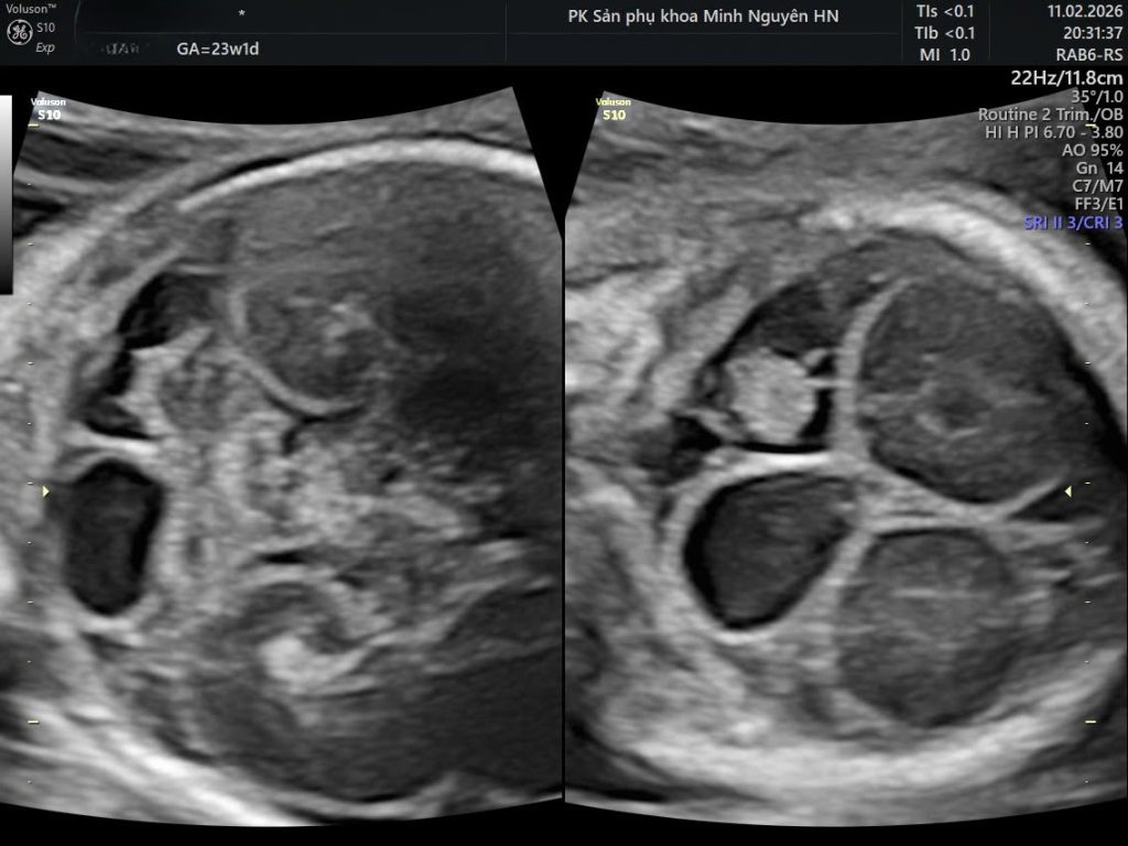 Hình ảnh siêu âm nang màng nhện hố sau