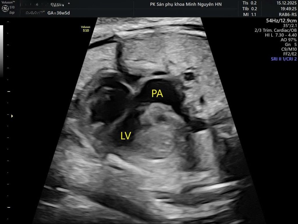 Hình chuyển vị đại động mạch (2)