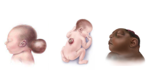 Phân loại các dị tật ống thần kinh